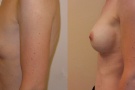 anatomický implantát menší velikosti použitý při zvětšení prsou pod žlázou a částečně pod sval