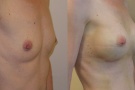zvětšení prsou anatomickým implantátem, střední augmentace pohled ze strany