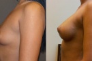 augmentace pod svalem i pod žlázou, pohled ze strany, střední zvětšení prsou kulatým silikonovým implantátem